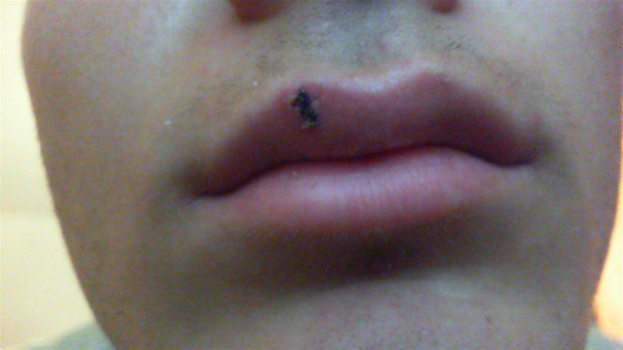 Hinterlässt eine genähte Lippe eine sichtbare Narbe? (Arzt, Gesicht, Narben)