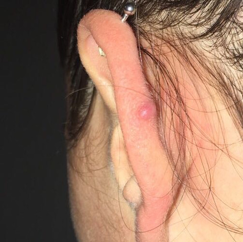 Hinterm Ohr Ein Knubbel Vom Piercing Wieso Geht Der Nicht Weg Gesundheit Und Medizin Entzundung