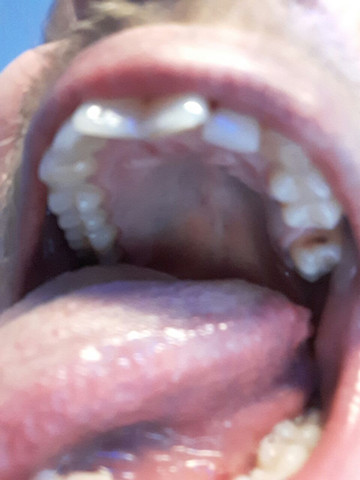 10+ Pickel Auf Der Zunge Hinten Kinder Pics