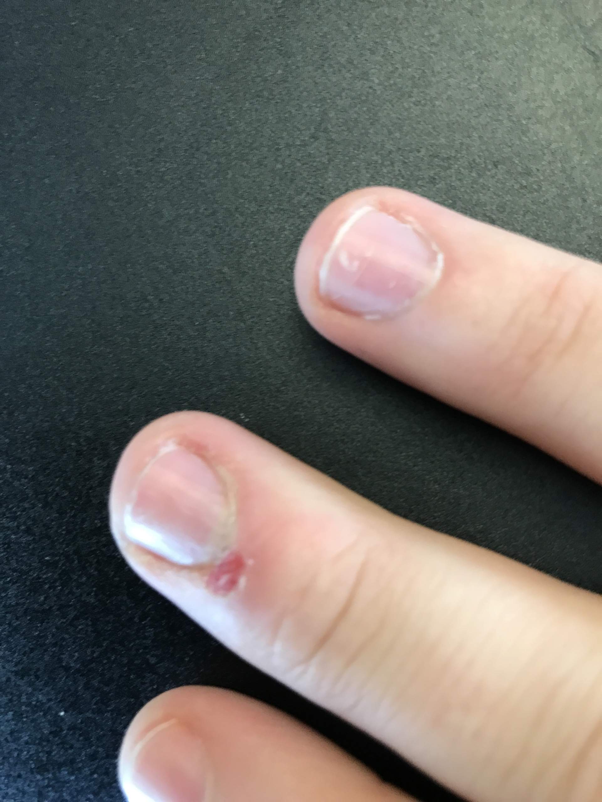 Hiv durch nässende Wunde? (Infektion, AIDS)