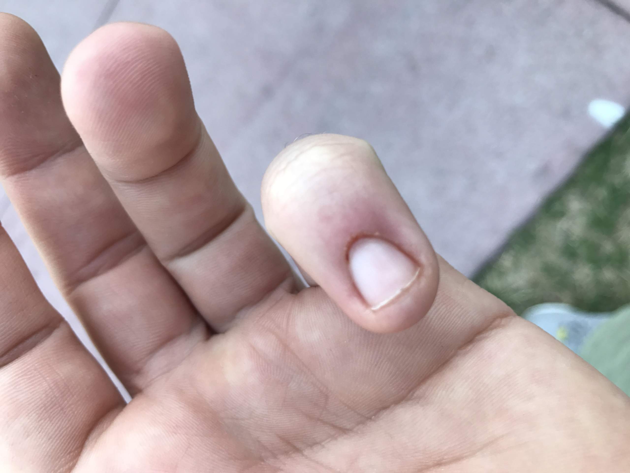 Hiv durch Wunde möglich? (AIDS)