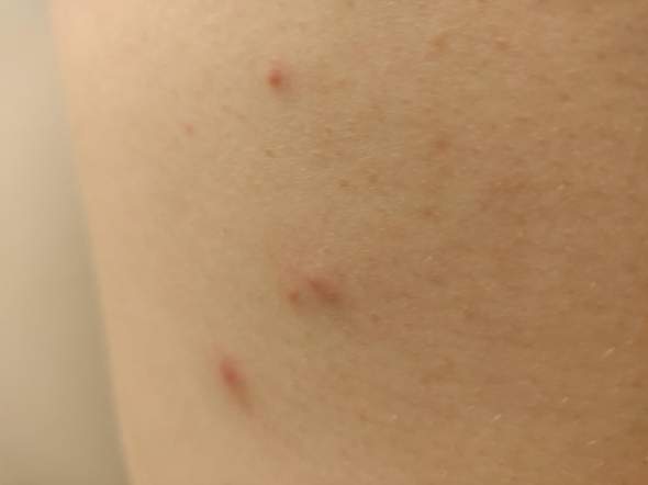 Hiv Hautausschlag Exanthem Krankheit