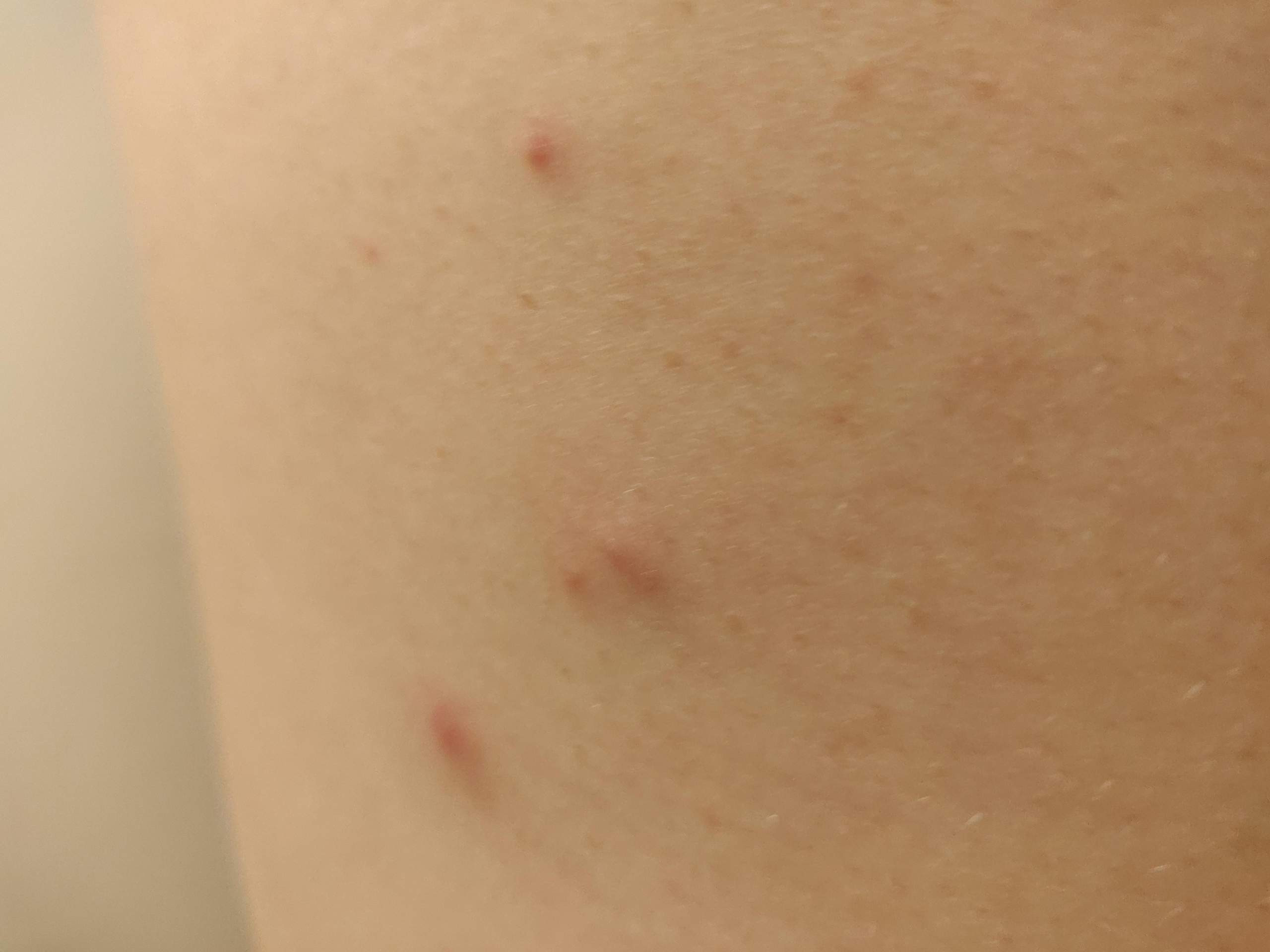 Ausschlag hiv Como Identificar