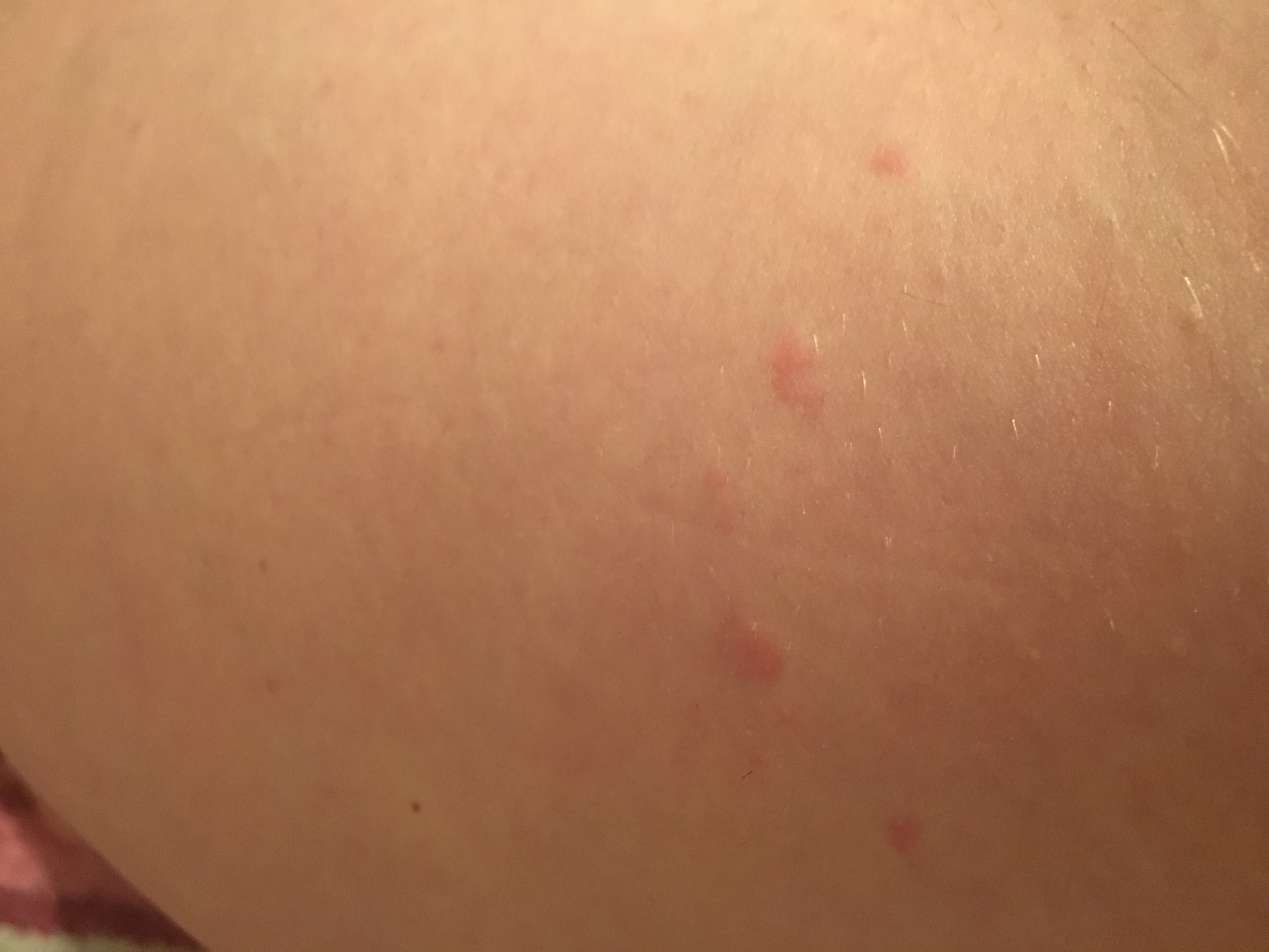 Hiv Oder Nur Hautausschlag Gesundheit Und Medizin Arzt Angst