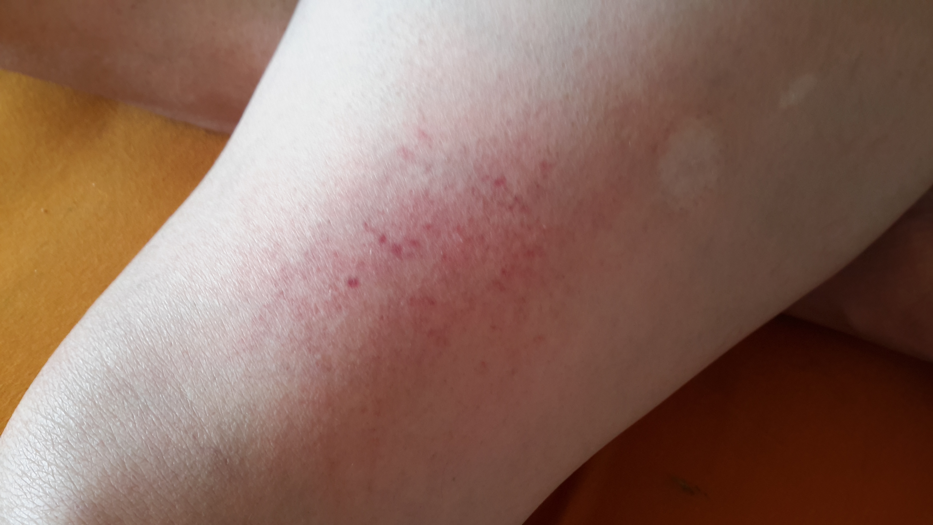 Hlife plötzliche rötung über dem Knie ? (Beine) Hlife plötzliche rötung über dem Knie ? (Beine)