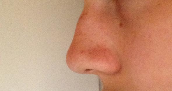 Hocker Auf Der Nase Beauty Hocker Auf Der Nase Beauty