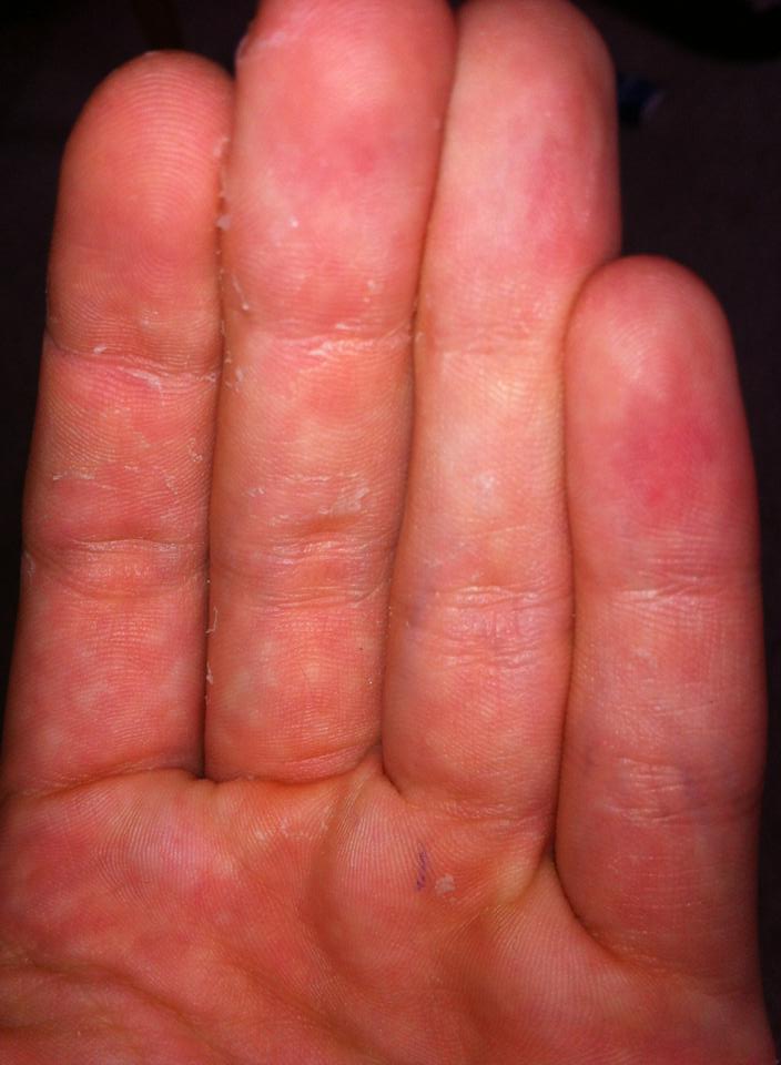 Hornhaut an Händen pellt sich (Hand)