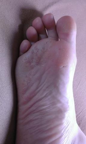 Meine Fußsohle - (Haut, Füße, Pilze)