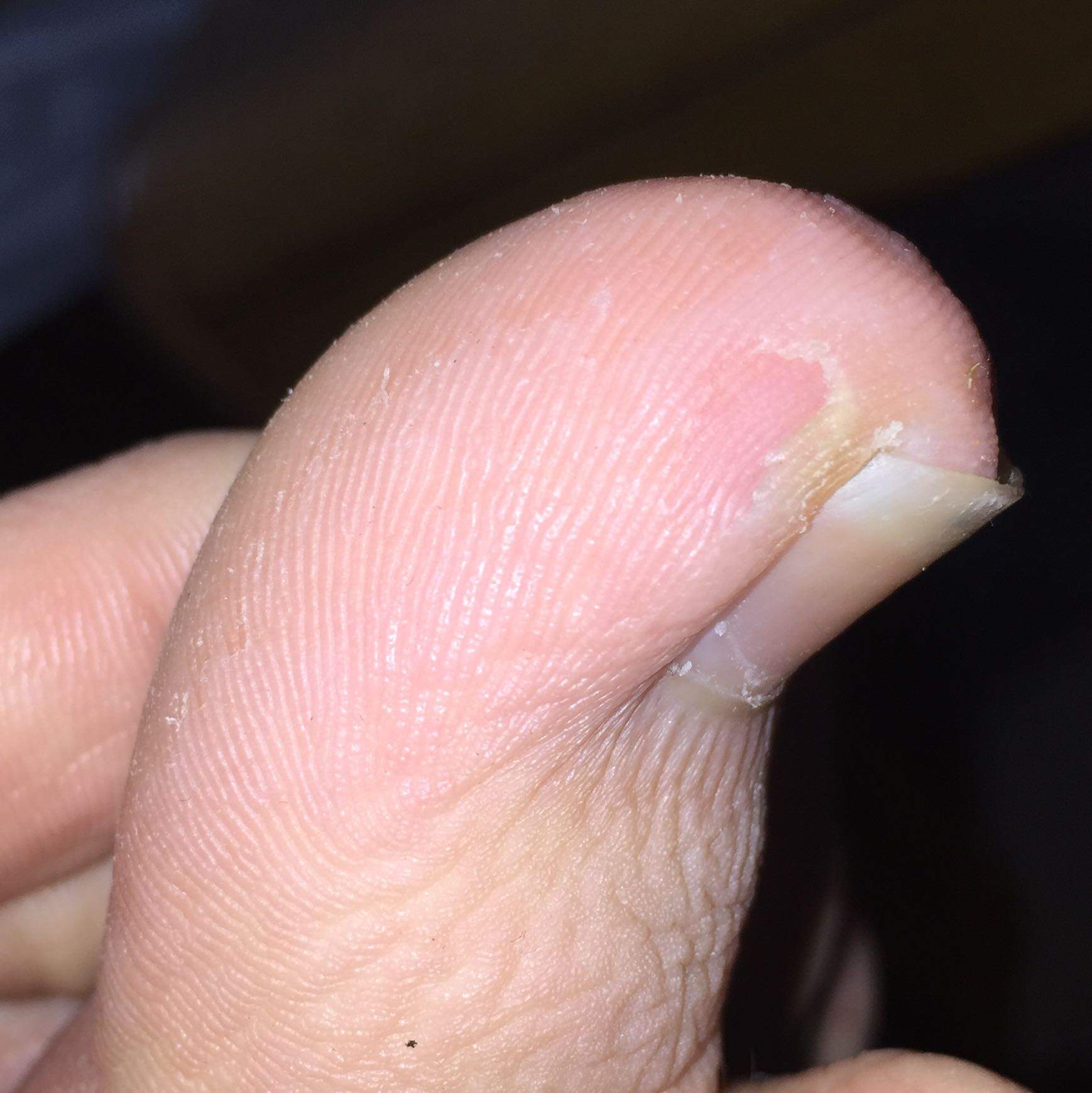 Hornhaut Schalt Sich Am Grossen Zeh Haut Fusse Hautarzt Hornhaut Schalt Sich Am Grossen Zeh Haut Fusse Hautarzt