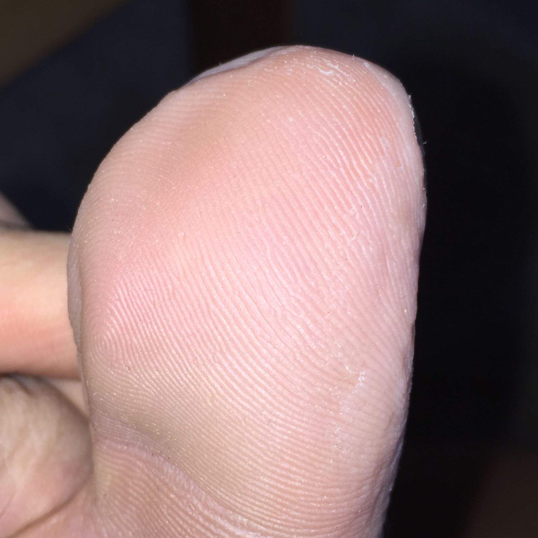 Hornhaut schält sich am Großen Zeh? (Haut, Füße, Hautarzt)