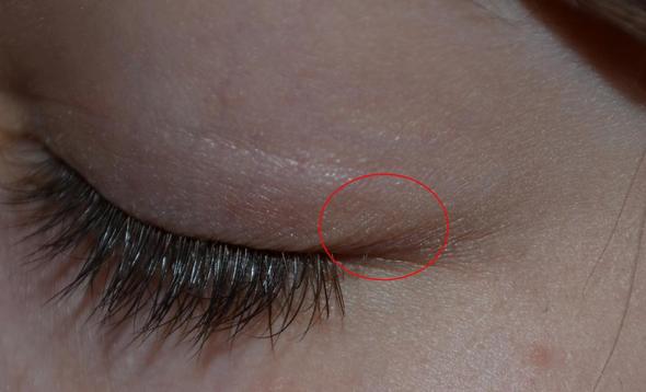 es ist nicht am auge! - (Augen, Hubbel)