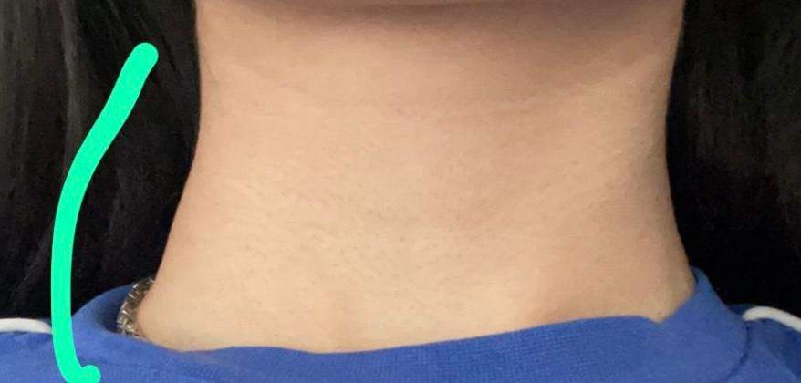 Hubble bzw. knoten am Hals? (Gesundheit und Medizin, Sorgen)