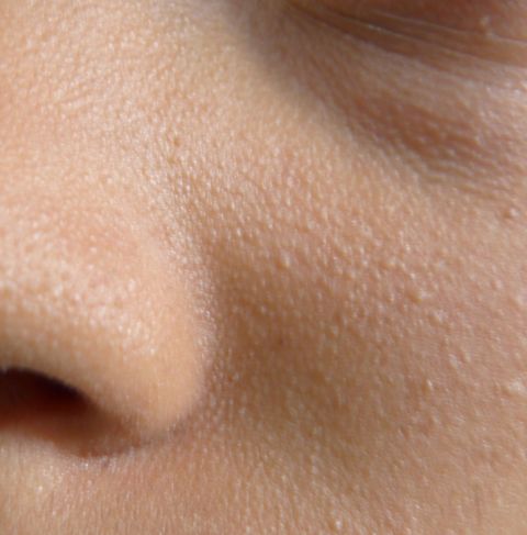 Sonnenallergie Was Nun Www Allergikamagazin De Sonnenallergie Was Nun Www Allergikamagazin De