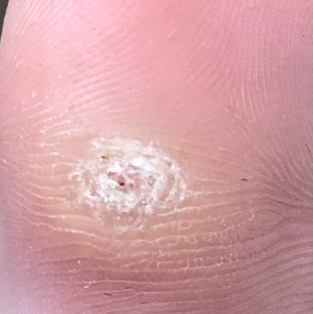 Hühnerauge ja oder nein ? (Gesundheit und Medizin)