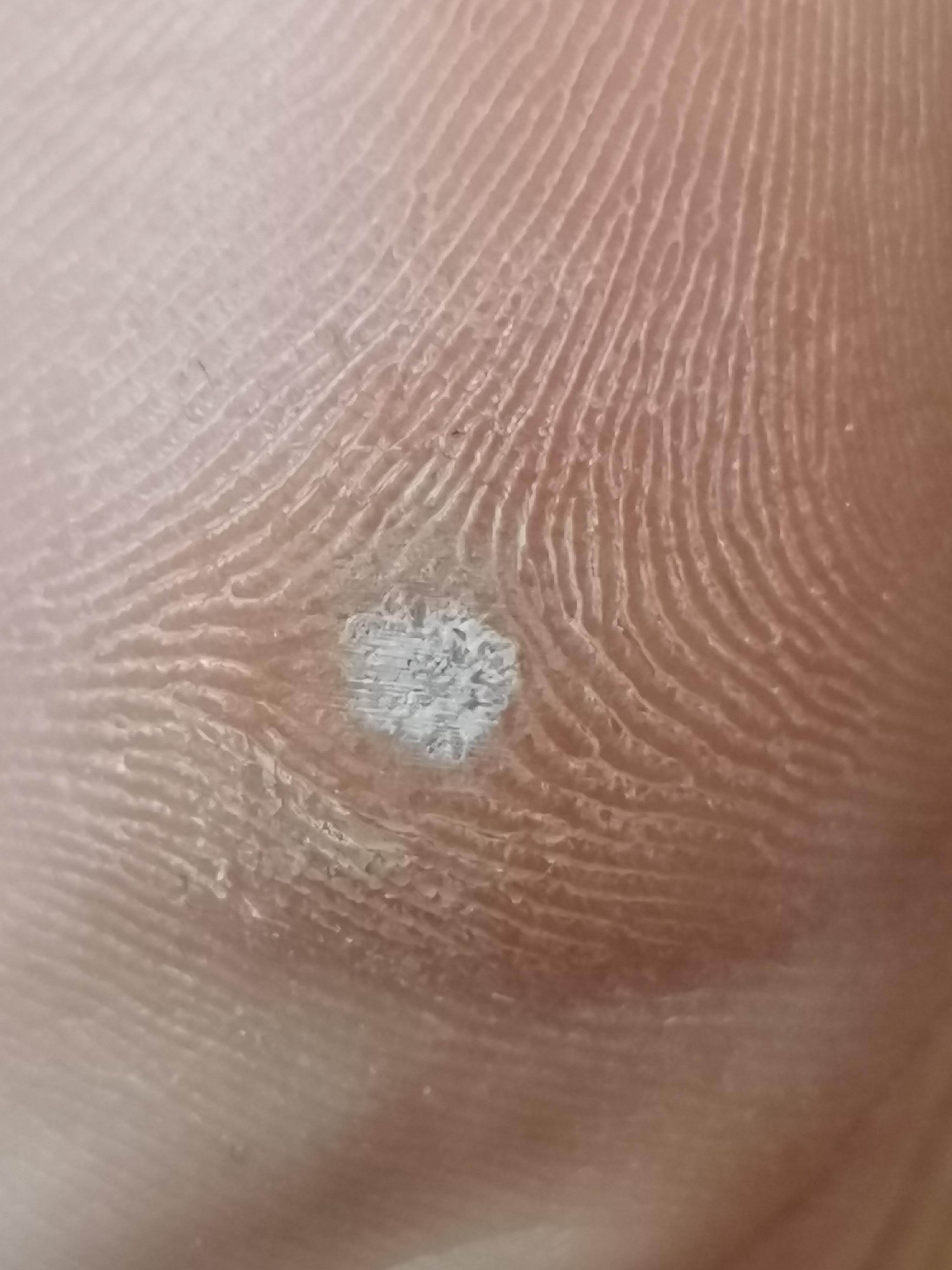 Hühnerauge oder Warze Bild? (Füße, Warzen) Hühnerauge oder Warze Bild? (Füße, Warzen)