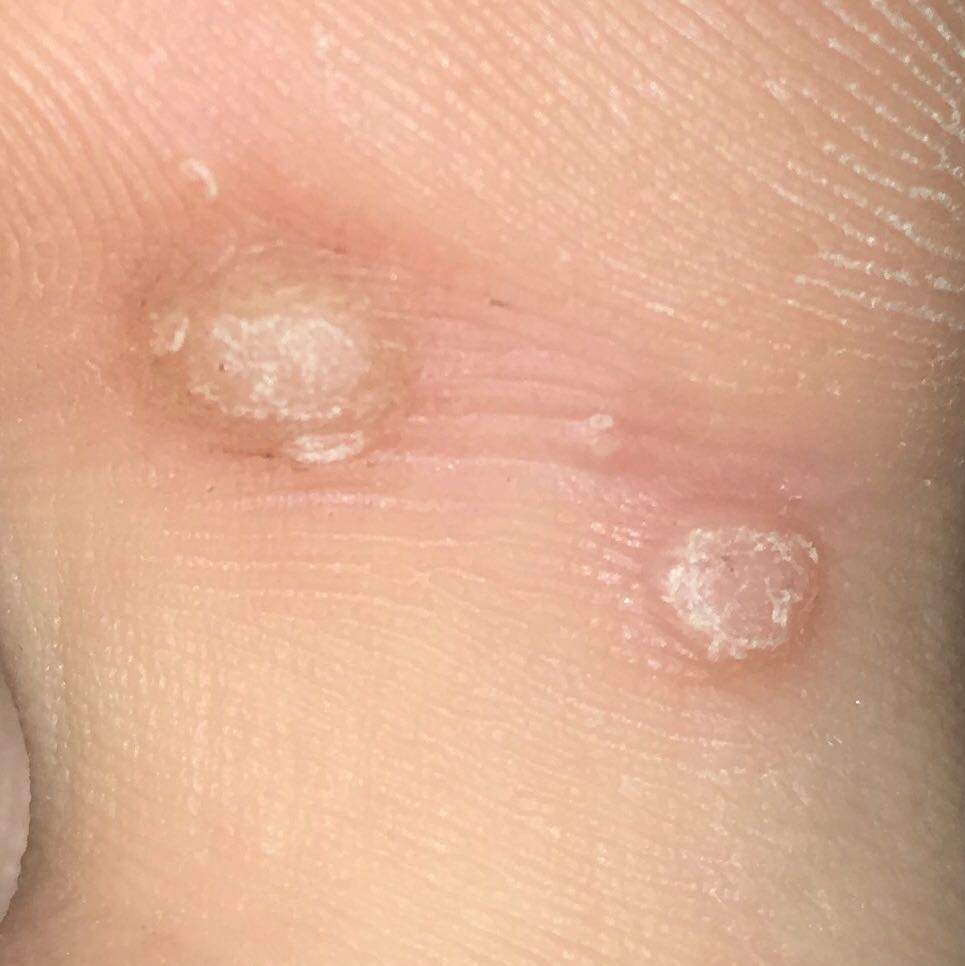 Hühneraugen oder warzen? (Haut, Hühnerauge)