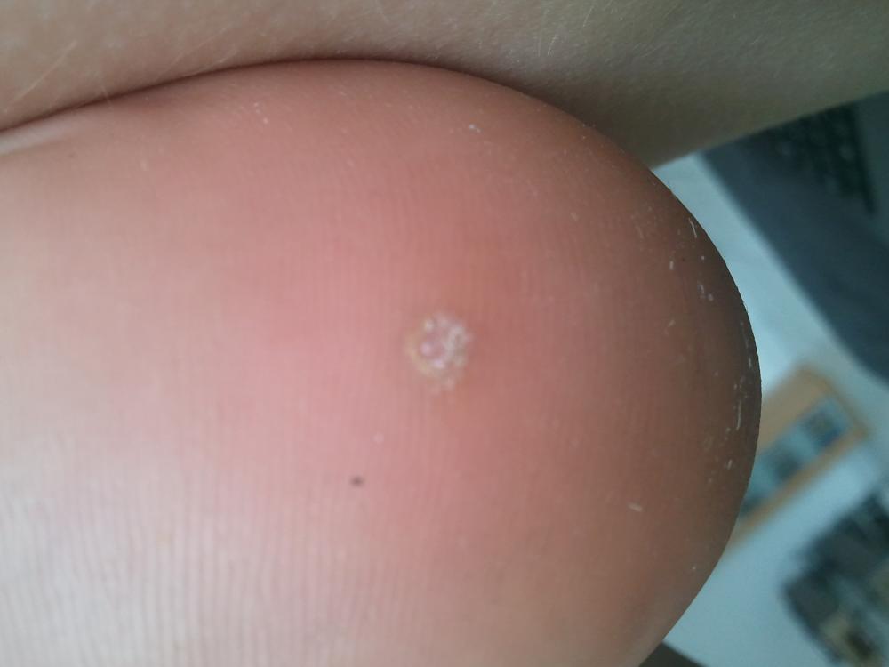 hünerauge was kann ich dagegen tun (Gesundheit, entfernen, Ferse) hünerauge was kann ich dagegen tun (Gesundheit, entfernen, Ferse)