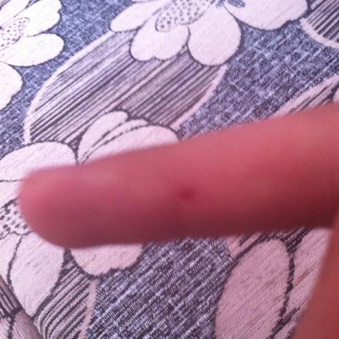 Mein finger 2-3 tage nach dem biss. Entzündung ? - (Entzündung, Hundebiss)