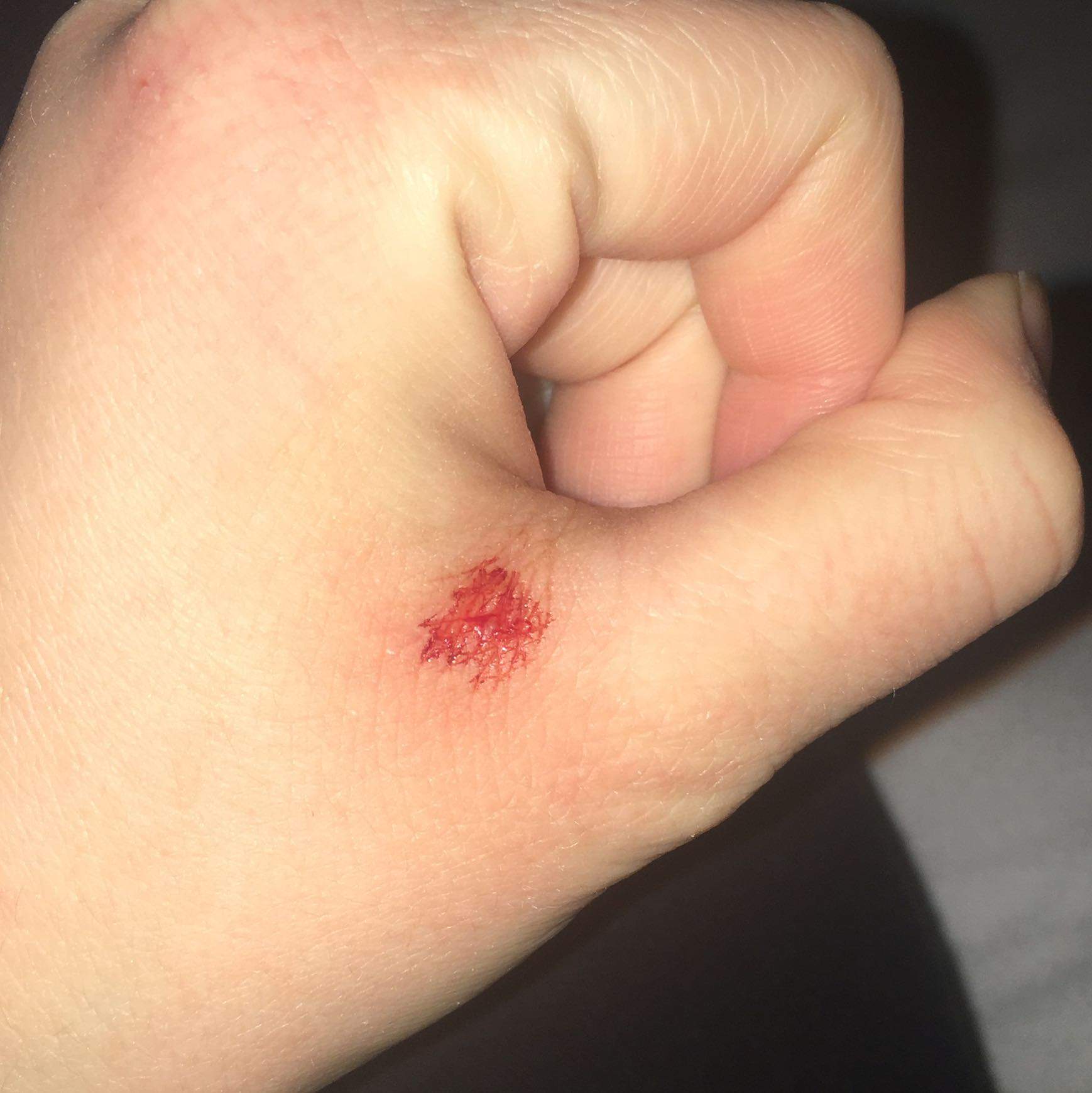 Wann sollte man nach einem Hundebiss einen Arzt aufsuchen? Wann sollte man nach einem Hundebiss einen Arzt aufsuchen?