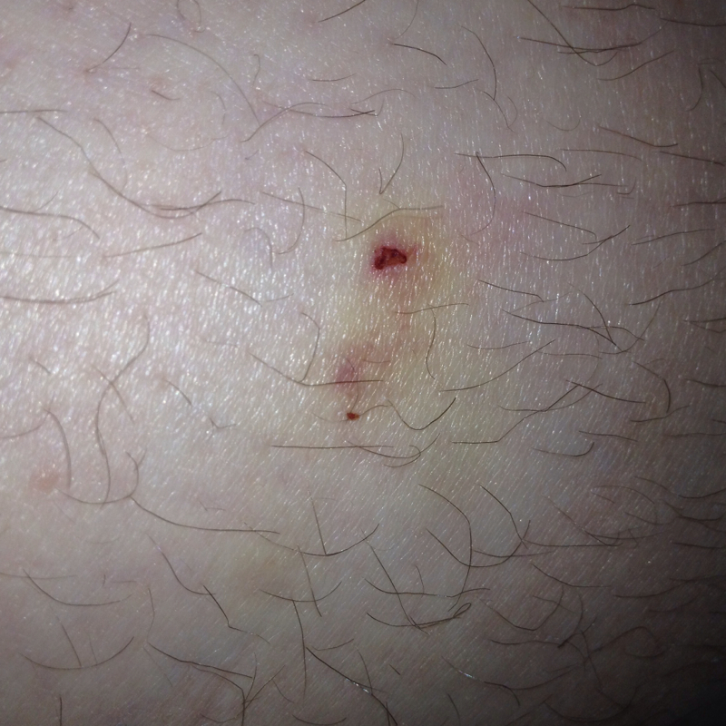 Hundebiss vor 4 tagen! (tollwut)