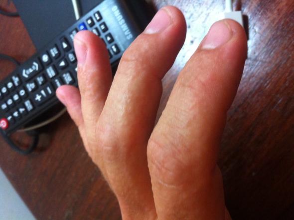 Weiße Pickel an Fingern und Händen - links - (Gesundheit, Haut, Pickel)