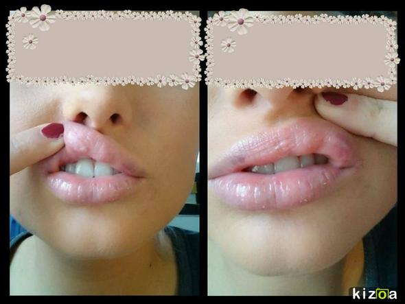 Lange geschwollen lippen aufspritzen wie Lippen aufspritzen
