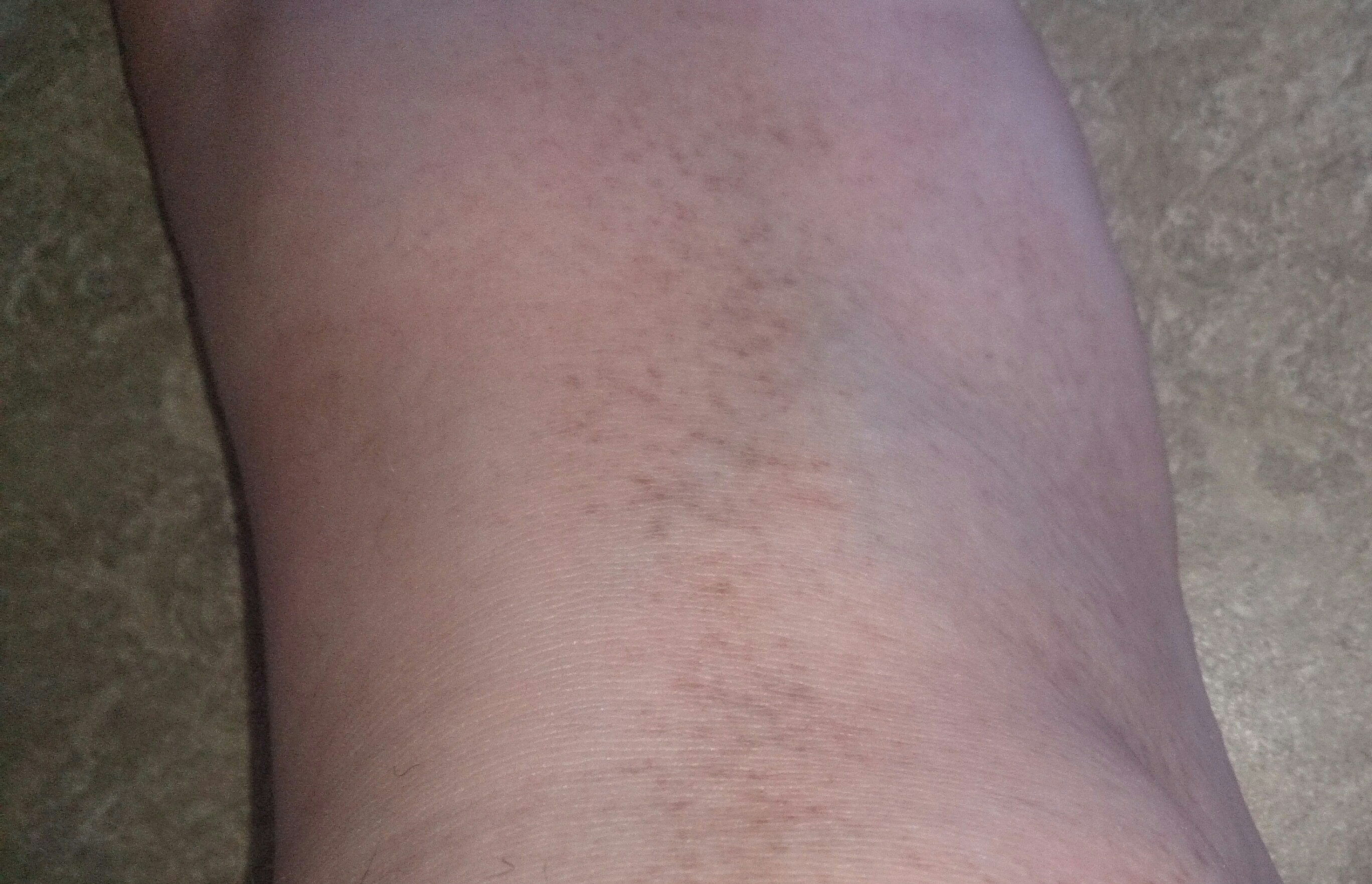 ich bekomme auf einmal überall braune flecken (Haut, Pigmente)