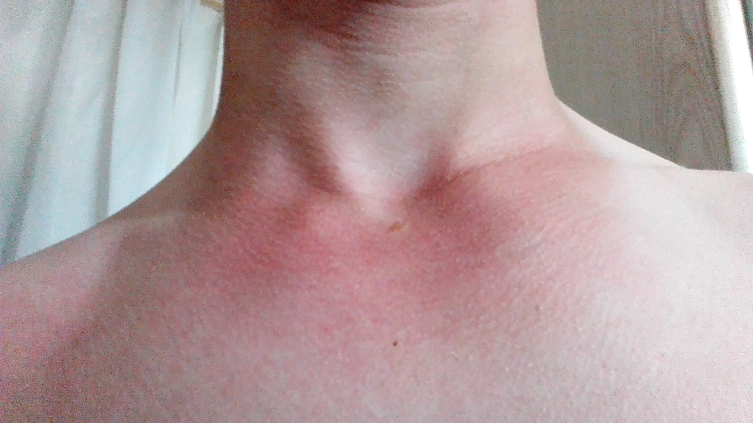 Ich bin immer rot unter dem Hals & im Gesicht.. Was kann man dagegen machen ich wills nicht mehr Ich bin immer rot unter dem Hals & im Gesicht.. Was kann man dagegen machen ich wills nicht mehr