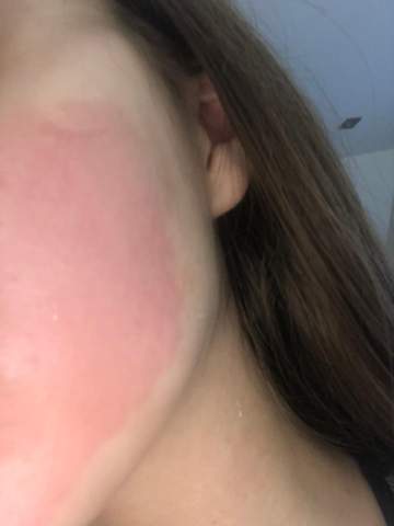 Ich Bin Komplett Rot Nach Pflegeprodukten Auf Gesicht Gesundheit Und Medizin Beauty Pflege