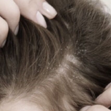 Ich Bitte Um Hilfe Wie Geht Der Mist Weg Kopfhaut Schuppenflechte