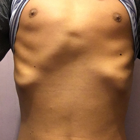 Ich Brauche Eure Hilfe Meine Rippen Sind Verformt Gesundheit Medizin Orthopadie Ich Brauche Eure Hilfe Meine Rippen Sind Verformt Gesundheit Medizin Orthopadie