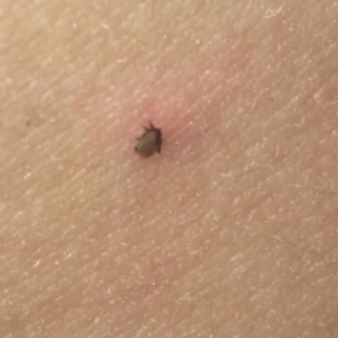 Ich Brauche Hilfe Das Stechwerkzeug Einer Zecke Ist In Meiner Haut Stecken Geblieben Gesundheit Medizin Korper Ich Brauche Hilfe Das Stechwerkzeug Einer Zecke Ist In Meiner Haut Stecken Geblieben Gesundheit Medizin Korper