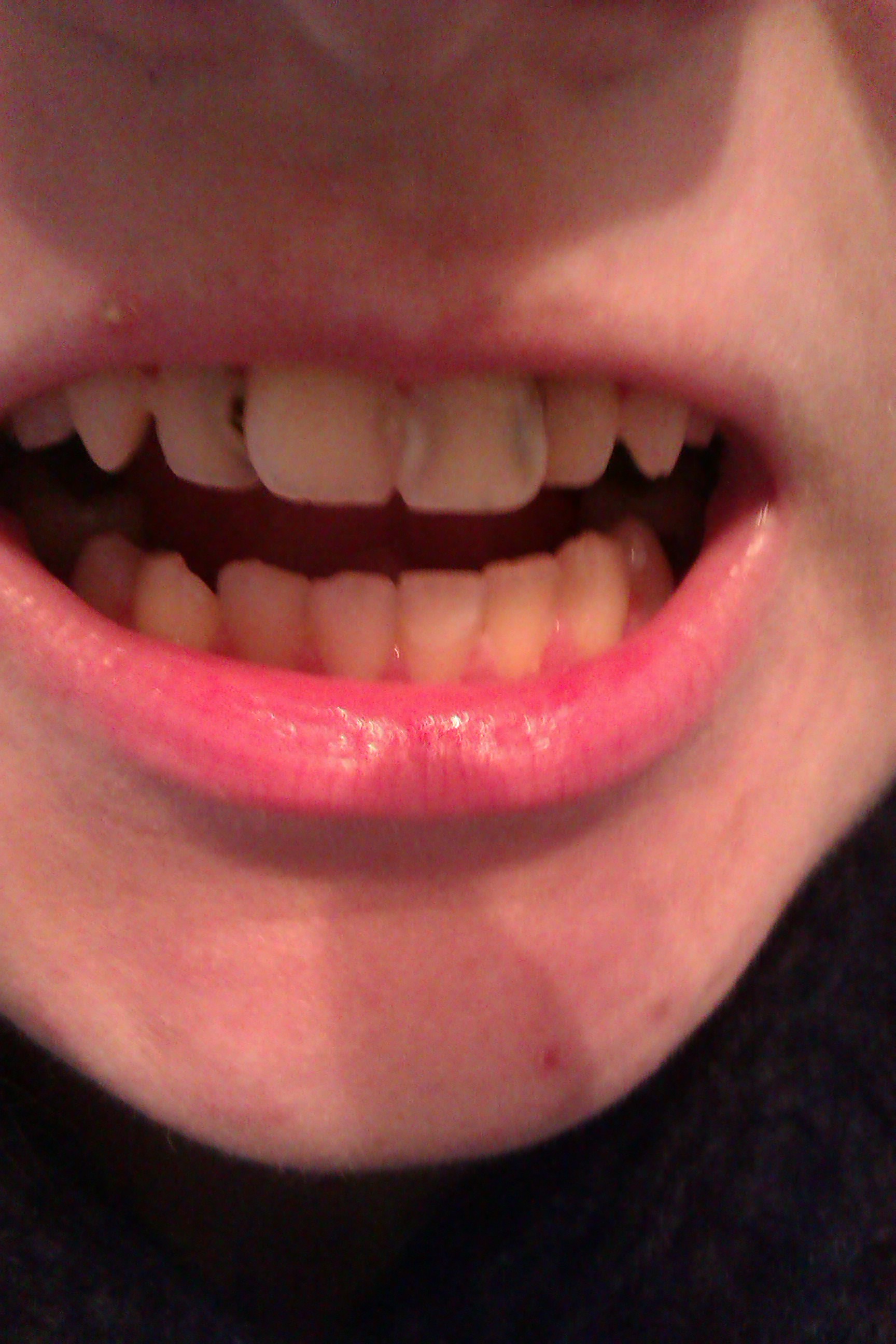 Ich Brauche Neue Zahne Was Soll Ich Tun Was Sind Die Kosten Gesundheit Geld Zahnarzt