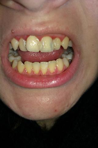 Ich Brauche Neue Zahne Was Soll Ich Tun Was Sind Die Kosten Gesundheit Geld Zahnarzt Ich Brauche Neue Zahne Was Soll Ich Tun Was Sind Die Kosten Gesundheit Geld Zahnarzt