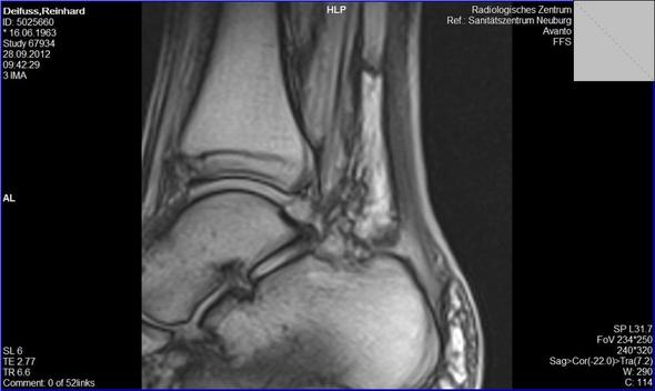 Ich Glaube Ich Habe Einen Wadenbeinbruch Gesundheit Korper Beine Ich Glaube Ich Habe Einen Wadenbeinbruch Gesundheit Korper Beine