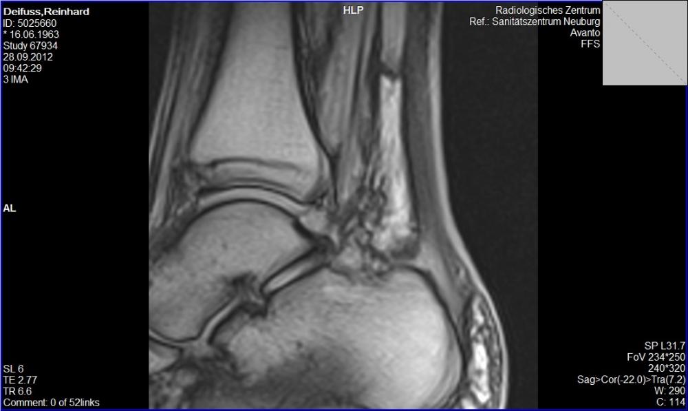 Ich glaube ich habe einen Wadenbeinbruch! (Gesundheit, Körper, Beine)