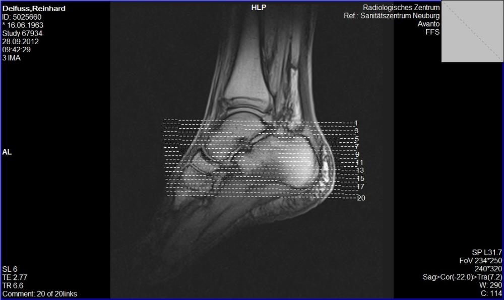 Ich glaube ich habe einen Wadenbeinbruch! (Gesundheit, Körper, Beine)