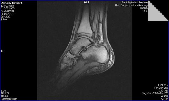 Ich Glaube Ich Habe Einen Wadenbeinbruch Gesundheit Korper Beine Ich Glaube Ich Habe Einen Wadenbeinbruch Gesundheit Korper Beine