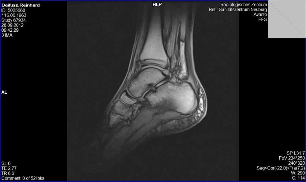 Ich glaube ich habe einen Wadenbeinbruch! (Gesundheit, Körper, Beine)