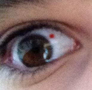 Auge mit rotem Punkt - (Augen, rot)