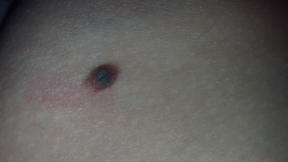 Ich Hab Ein Muttermal Wo Am Anfang Ein Kleiner Schwarzer Punkt Drin War Jetzt Ist Er Gross Und Dicker Geworden Ist Da Vllt Blut Unten Drunter Bin Dagegen Gekom Gesundheit Und Medizin