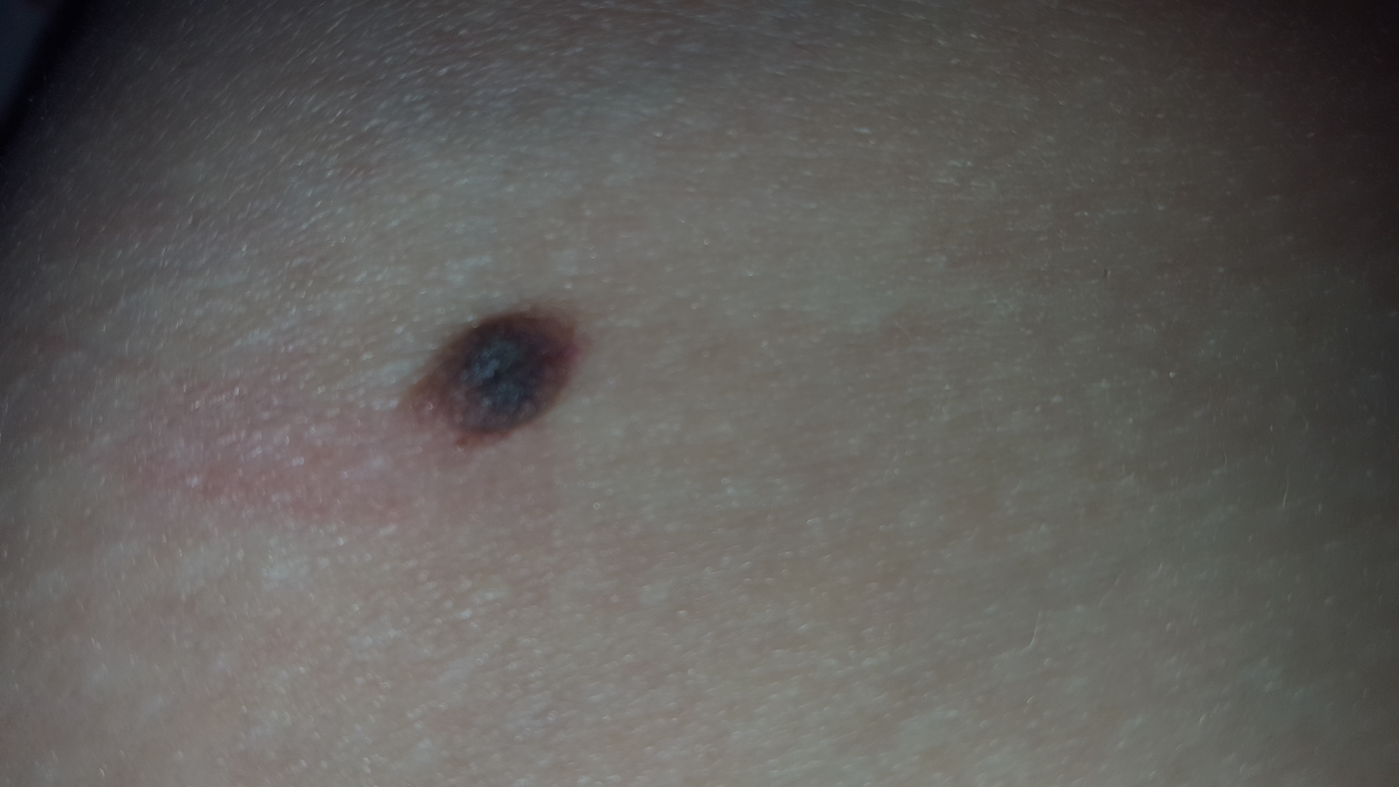 Ich hab ein Muttermal wo am Anfang ein kleiner schwarzer Punkt drin war