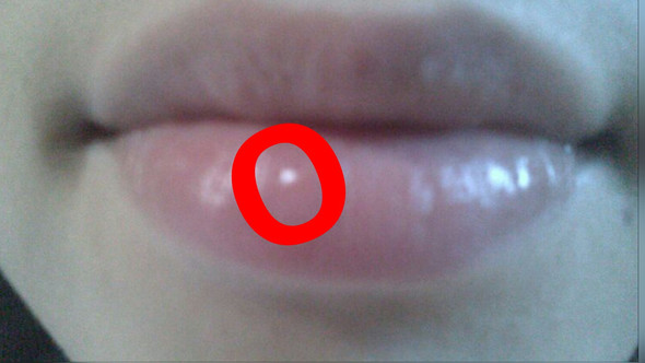 Ich Hab Einen Buckel Auf Unterlippe Lippe Knoten Ich Hab Einen Buckel Auf Unterlippe Lippe Knoten