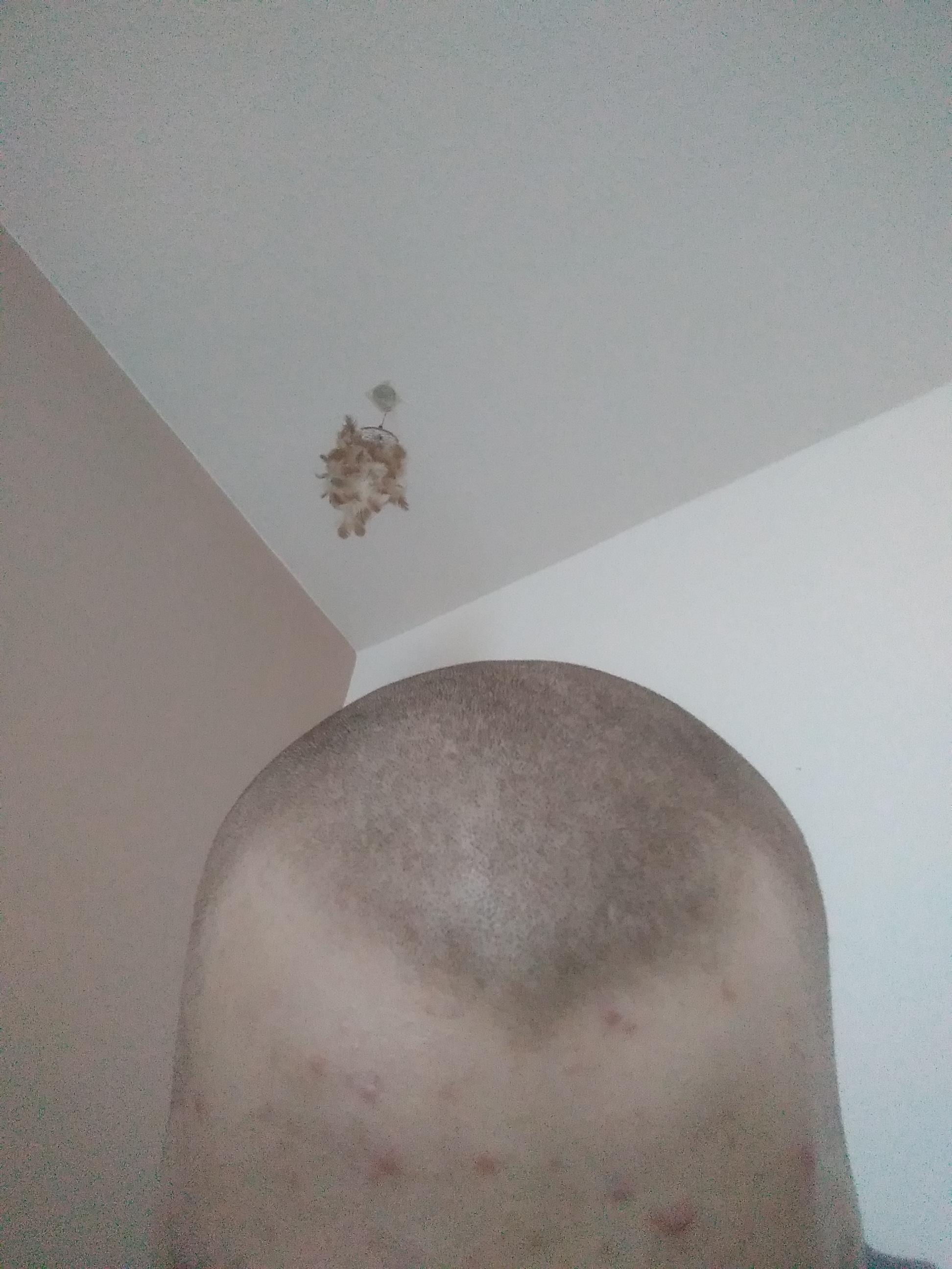 ich hab haarausfall aber meine haare