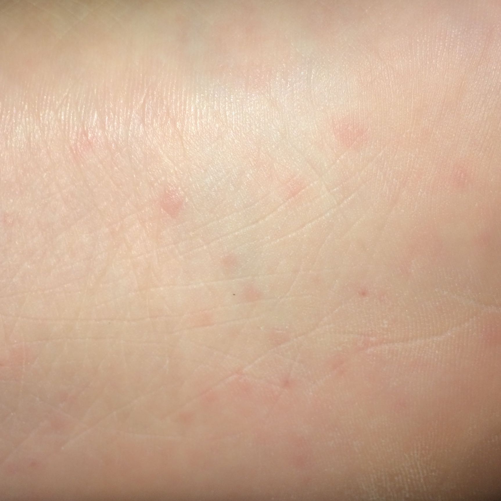 Ich hab lauter so kleine rote Punkt unter meinem fuß und die jucken was