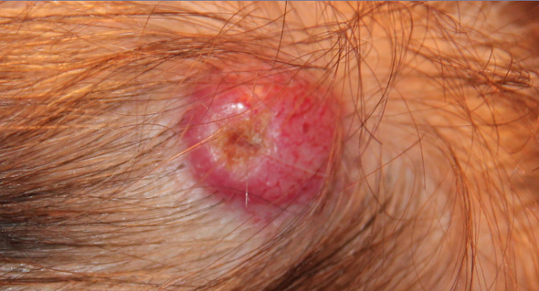 Ich Hab Seit Ca 1 Jahr Am Kopf Unter Der Kopfhaut Ein Knubbel Was Kann Das Sein Gesundheit Medizin