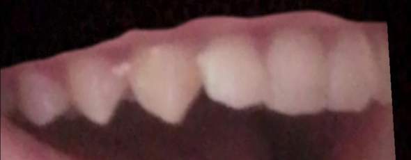 Ich hab Vampir Zähne?