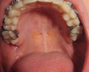 Gaumen Die Meistgelesenen Fragen Gaumen Die Meistgelesenen Fragen