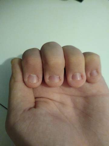 ich habe abgekaute nagel wie kann sie schon wachsen lassen nagelkauen 