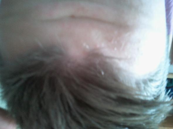 Stirn mit mit fehlenden Haaren in der Mitte - (Haare, Friseur, Haarausfall)